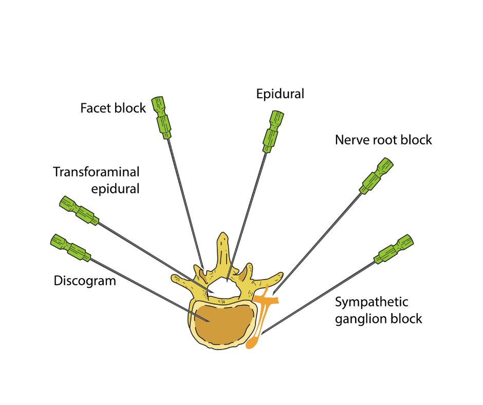 Spinal Injections